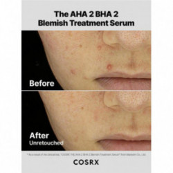 COSRX The AHA 2 BHA 2 Blemish Treatment Serum Serums problemātiskai ādai 50g