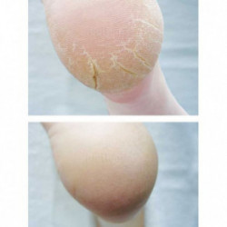 Footlogix Cracked Heel Formula Putas saplaisājušām pēdām 125ml