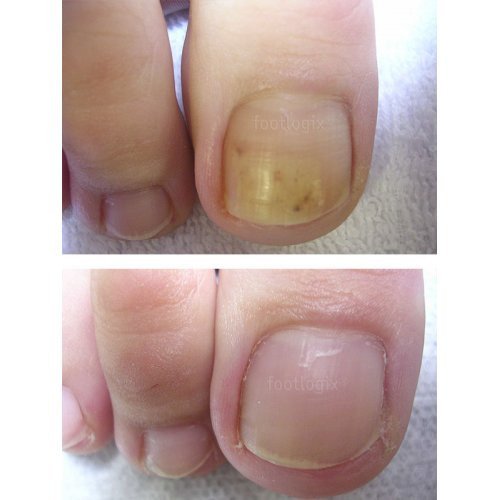 Footlogix Anti-Fungal Toe Tincture Spray Pretsēnīšu līdzeklis kāju nagiem 50ml