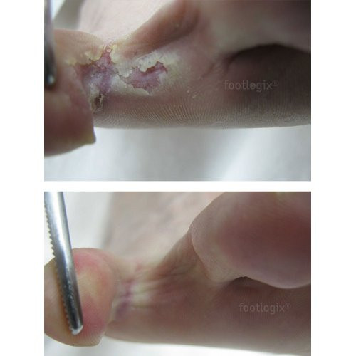 Footlogix Peeling Skin Formula Pretsēnīšu līdzeklis pēdām 125ml